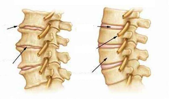 Kas yra osteochondrozė
