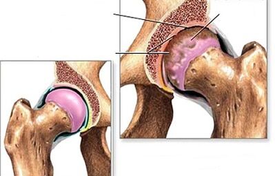HIP artrozės diagnozė