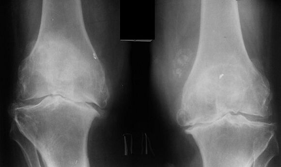 X -Rakis kaip būdas diagnozuoti kelio sąnario artrozę