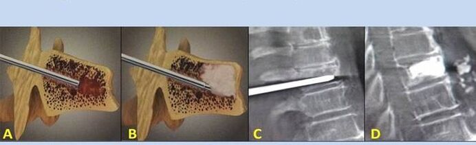 punkcinė vertebroplastika dėl nugaros skausmo