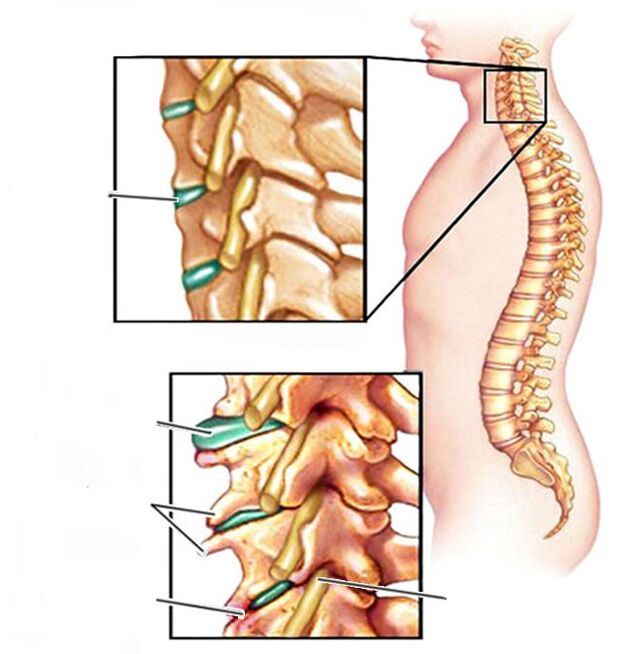 osteochondrozė ir sveikas kaklo stuburas