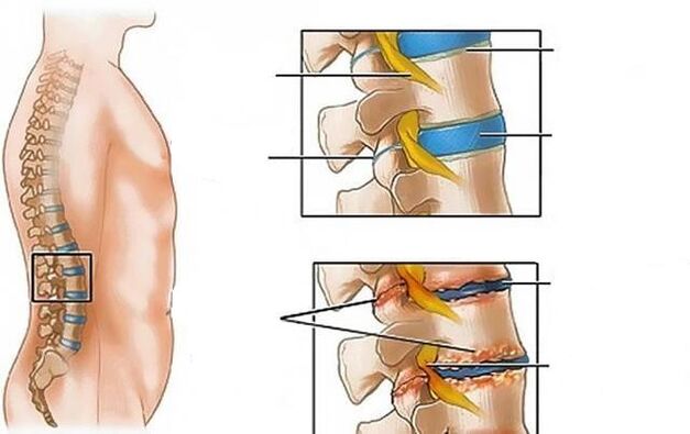 stuburo juosmeninės dalies osteochondrozė sukelia nugaros skausmus